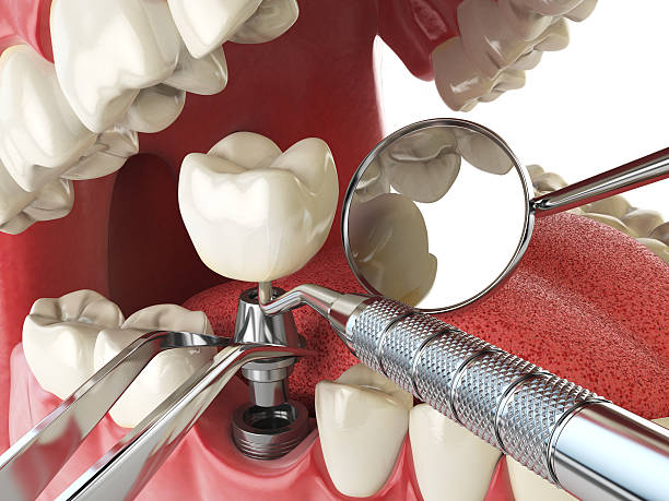 Best Emergency Dentist for Lost Fillings or Crowns in Moville, IA